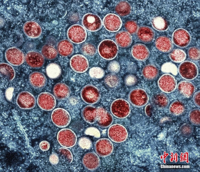 首次确诊！津巴布韦出现两例猴痘病例，均有国外旅行史